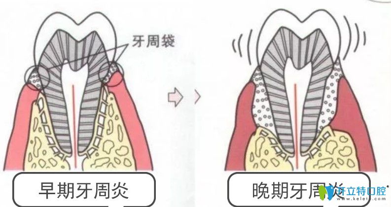 牙周病會導(dǎo)致牙槽骨被吸收