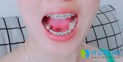 我在靖江艾齒嘉口腔戴牙套3個月 我在靖江艾齒嘉口腔戴牙套3個月