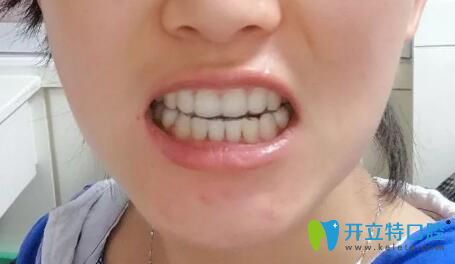 在靖江艾齒嘉口腔做牙齒矯正1年半 在靖江艾齒嘉口腔做牙齒矯正1年半