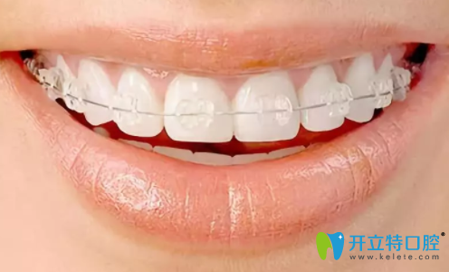 半隱形牙齒矯正明顯嗎？得從隱形和半隱形矯正的區(qū)別說起