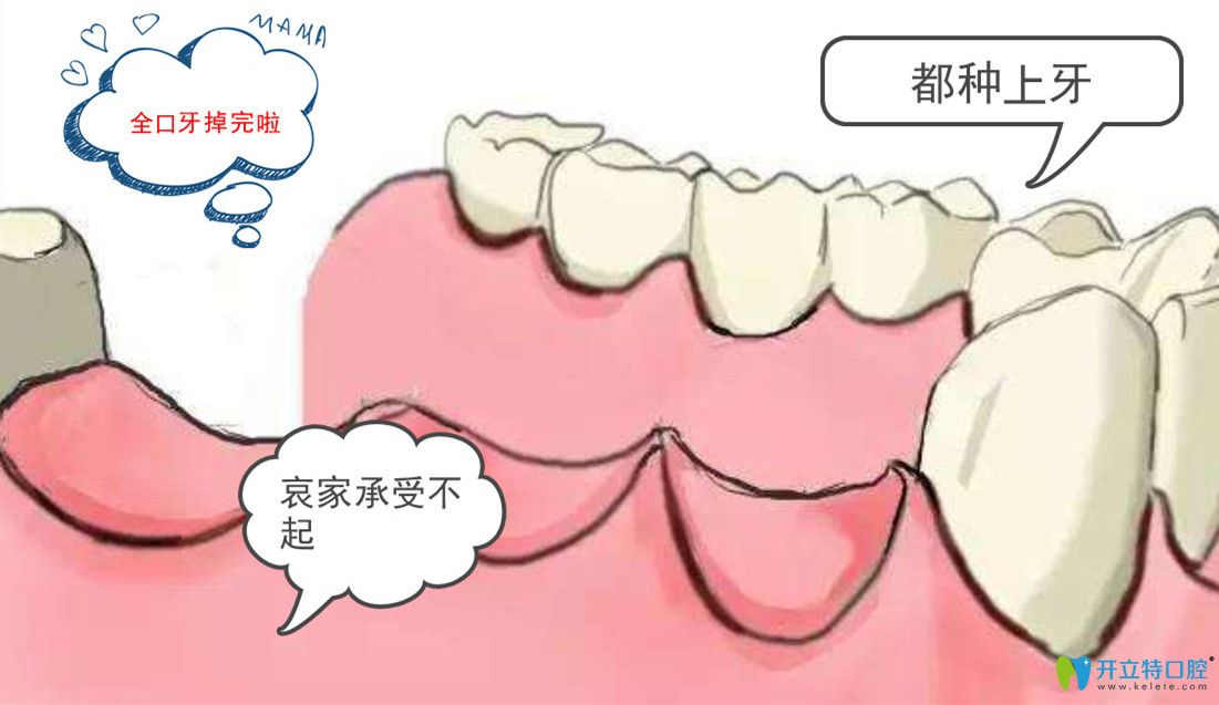 種植全口牙需要種幾顆？諾貝爾全口種植牙8顆多少錢?