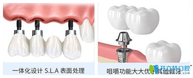 正夫口腔進(jìn)口種植體的優(yōu)勢