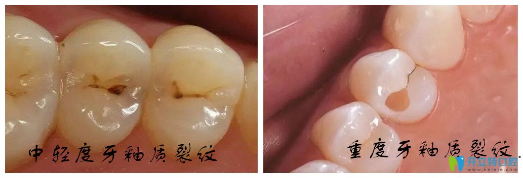 牙釉質(zhì)裂紋不同程度的比較