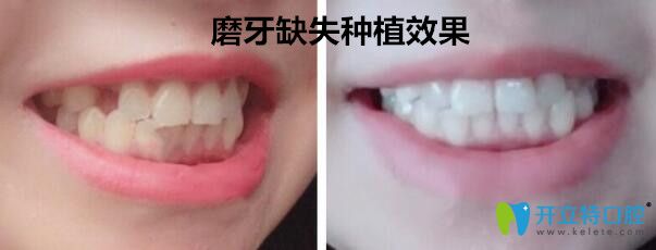 南京月牙兒口腔種植牙案例