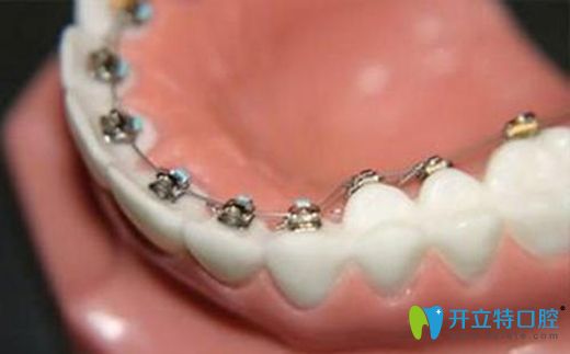 不影響美觀的舌側(cè)矯正技術