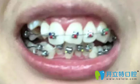 我剛戴金屬牙套矯正時的牙齒照