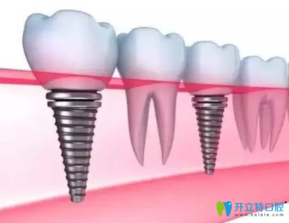 韓國登騰種植牙很差嗎？