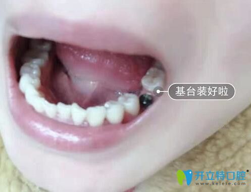 我在西安中諾口腔做種植牙過程