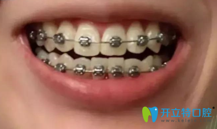 我虎牙外突側(cè)門牙扭轉(zhuǎn)，矯正兩年后的效果