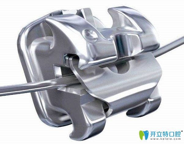 金屬自鎖托槽矯正圖片