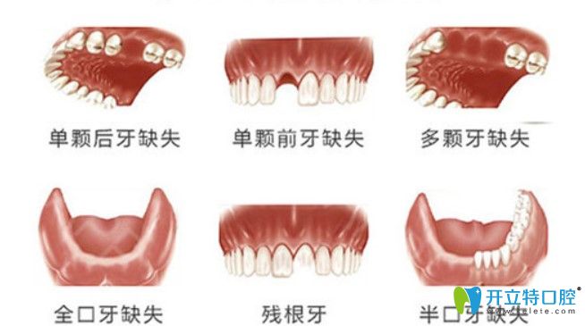 只要您的牙齒出現(xiàn)圖示問(wèn)題都可申請(qǐng)種植牙補(bǔ)貼