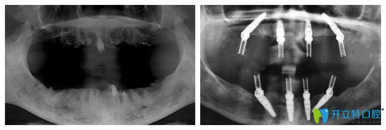靖江艾齒嘉口腔allon4種植牙CT片 靖江艾齒嘉口腔allon4種植牙CT片