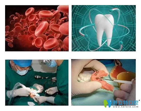 德國生長因子種植牙技術(shù)的優(yōu)勢