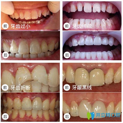 銘德口腔牙齒修復前后對比效果