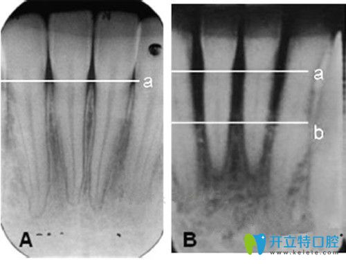 正常的牙槽骨和萎縮的牙槽骨