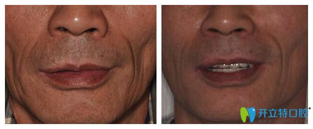 天津中諾口腔全口種植牙