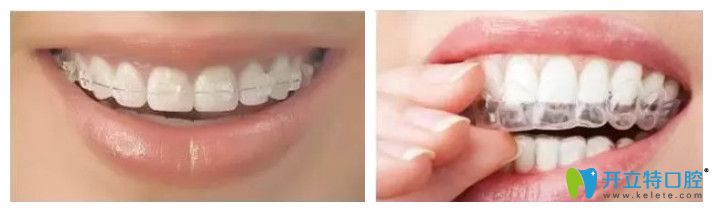 中山好民生口腔半隱形矯正和全隱形矯正價(jià)格