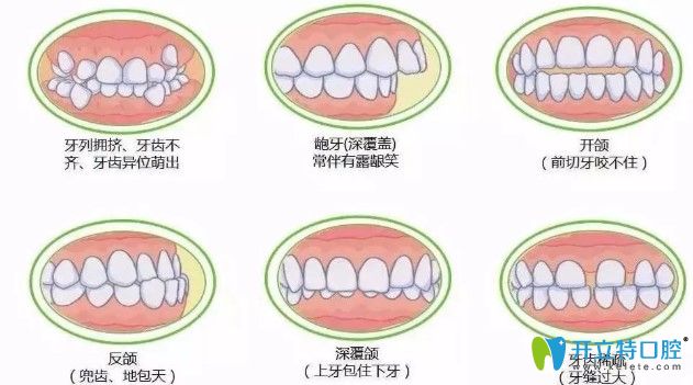 常燕醫(yī)生表示如圖所示的情況都會影響頜面發(fā)育