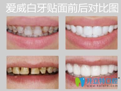 愛威白超薄牙貼面前后對比圖