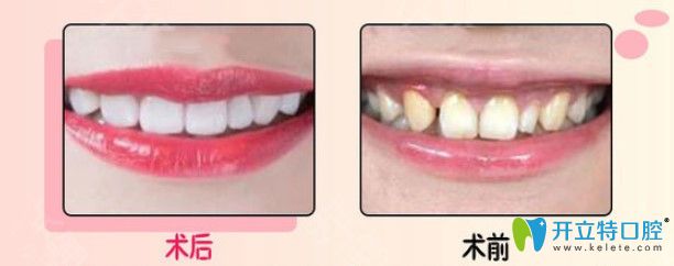 康美超薄牙貼面修復(fù)發(fā)黃牙齒對比照片 康美超薄牙貼面修復(fù)發(fā)黃牙齒對比照片