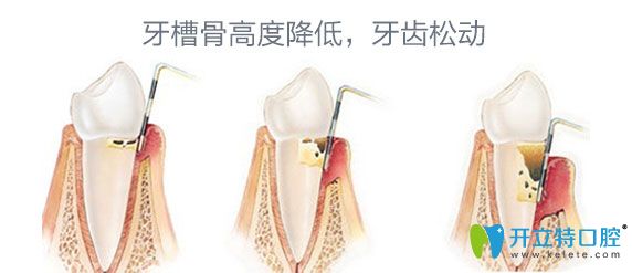 牙周病牙齒松動(dòng)