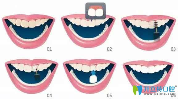牙齒貼面中的愛(ài)威白和美加哪個(gè)好,從價(jià)格和優(yōu)缺點(diǎn)區(qū)別吧！