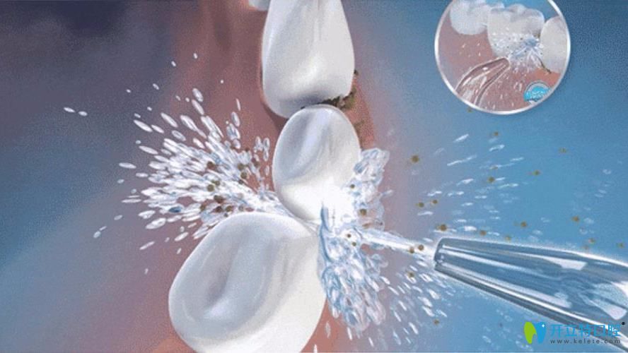 牙周基礎(chǔ)治療洗牙