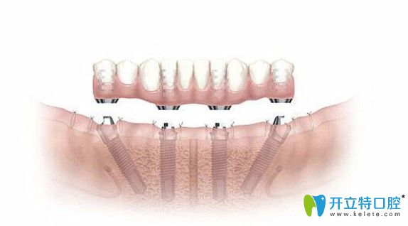 即刻種植牙當(dāng)天就能吃東西？