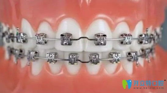 康美口腔進(jìn)口托槽矯正才12800元 康美口腔進(jìn)口托槽矯正才12800元