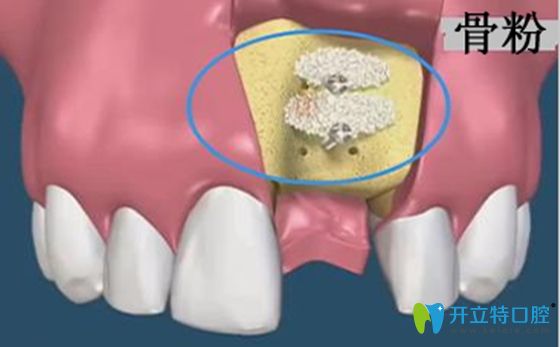 種牙齒填骨粉的利弊和不植骨種牙的后果分析
