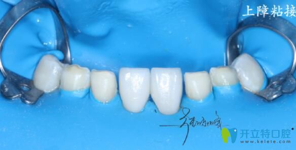 牙齒貼面上障粘結(jié)