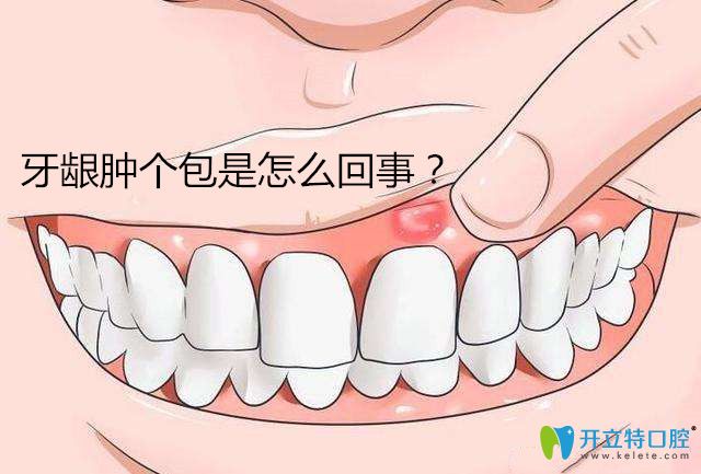 【有問必答】牙齦腫個(gè)包是怎么回事,怎么治療好的更快?