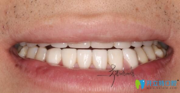 正夫口腔張東峰牙齒貼面真人案例