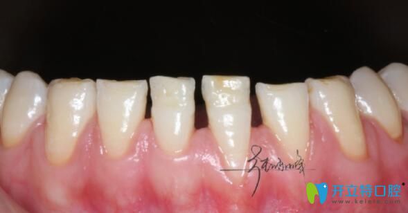 深圳牙齒貼面哪家醫(yī)院好