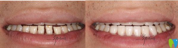 深圳正夫口腔醫(yī)院牙齒貼面真人案例