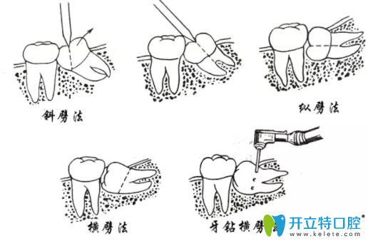 阻生牙一定要拔除嗎