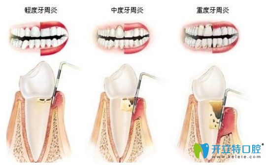 美奧口腔全口牙周治療價格