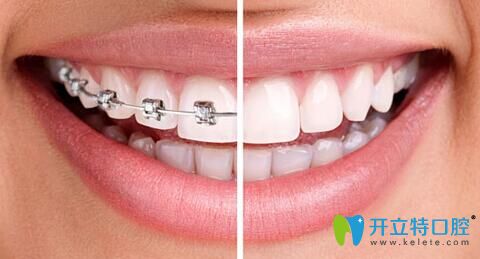 牙齒矯正的圖片
