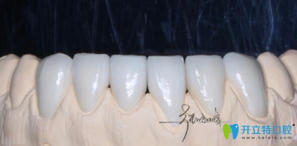 牙齒貼面?zhèn)溲缊D