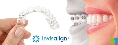 隱適美牙套怎么樣