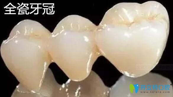 全瓷牙冠