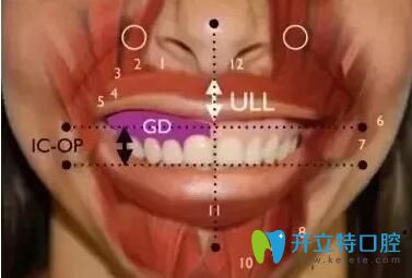 肌肉因素導致的露齦笑