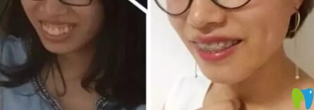 戴牙套能改善露齦笑嗎