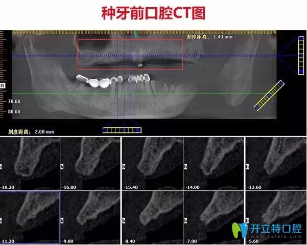 不了解珠海種牙哪家醫(yī)院好，不如看看仁愛口腔即刻種植牙