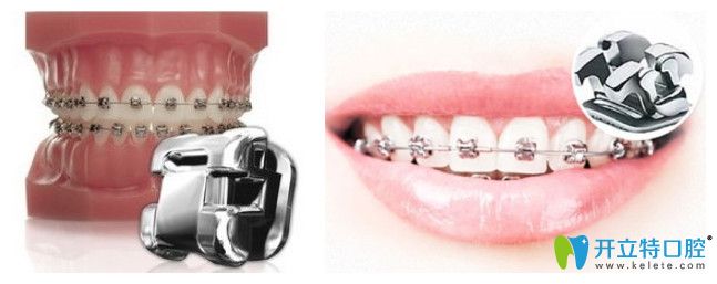 奧美科自鎖矯正與3m金屬自鎖矯正價格