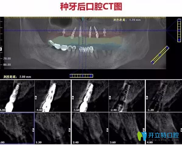 不了解珠海種牙哪家醫(yī)院好不如看看仁愛口腔德國種植牙