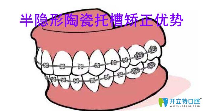 半隱形陶瓷托槽矯正優(yōu)勢(shì)