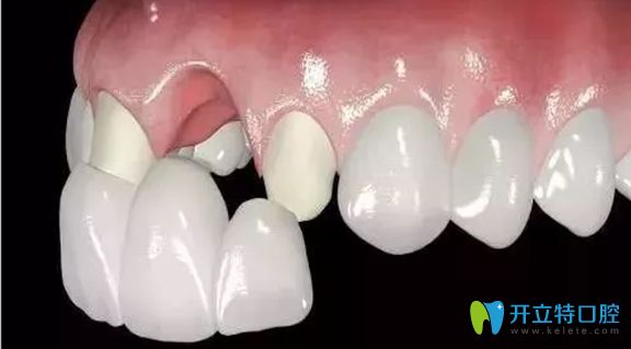 只有一兩顆烤瓷牙，還是可以考慮進(jìn)行牙齒矯正的
