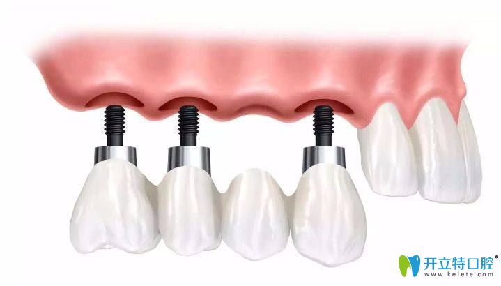 種植牙過(guò)程