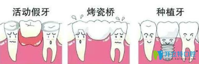 牙齒缺失可選擇種植牙進(jìn)行修復(fù)